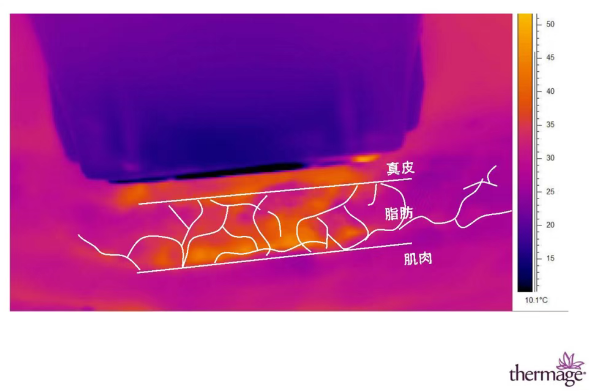 The terperature of Thermal Gradient of Thermage