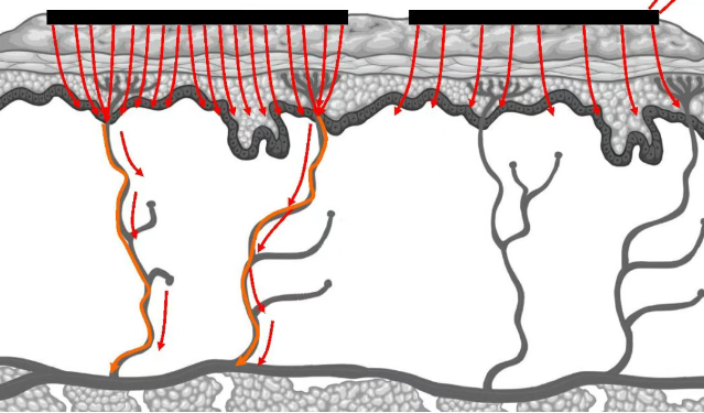 Monopolar RF with Return Electrode vs. Monopolar RF Without Return Electrode