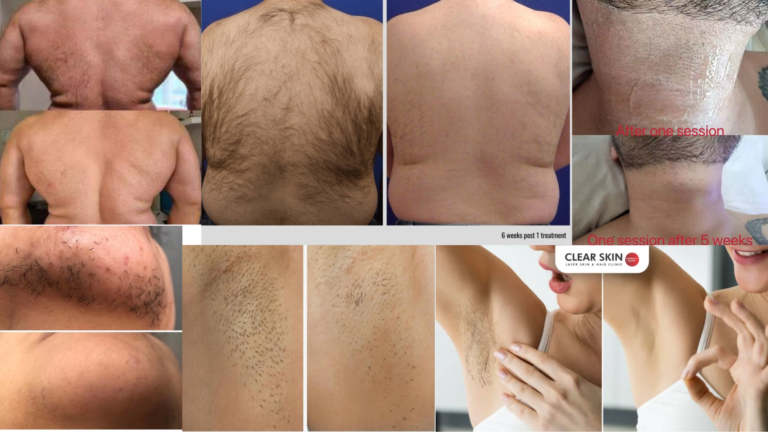 Épilation au laser avant et après