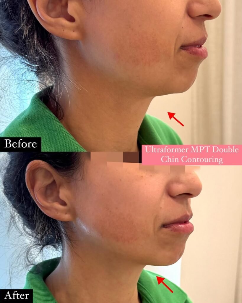 Amazing BEFORE AFTER for ULTRAFORMER MPT DOUBLE CHIN REDUCTION JAW CONTOURING, FAT REDUCTION AND TIGHTENING ONLY $ -Sessions LIMITED TIME OFFER DM us to book now for the offer experience the transformative