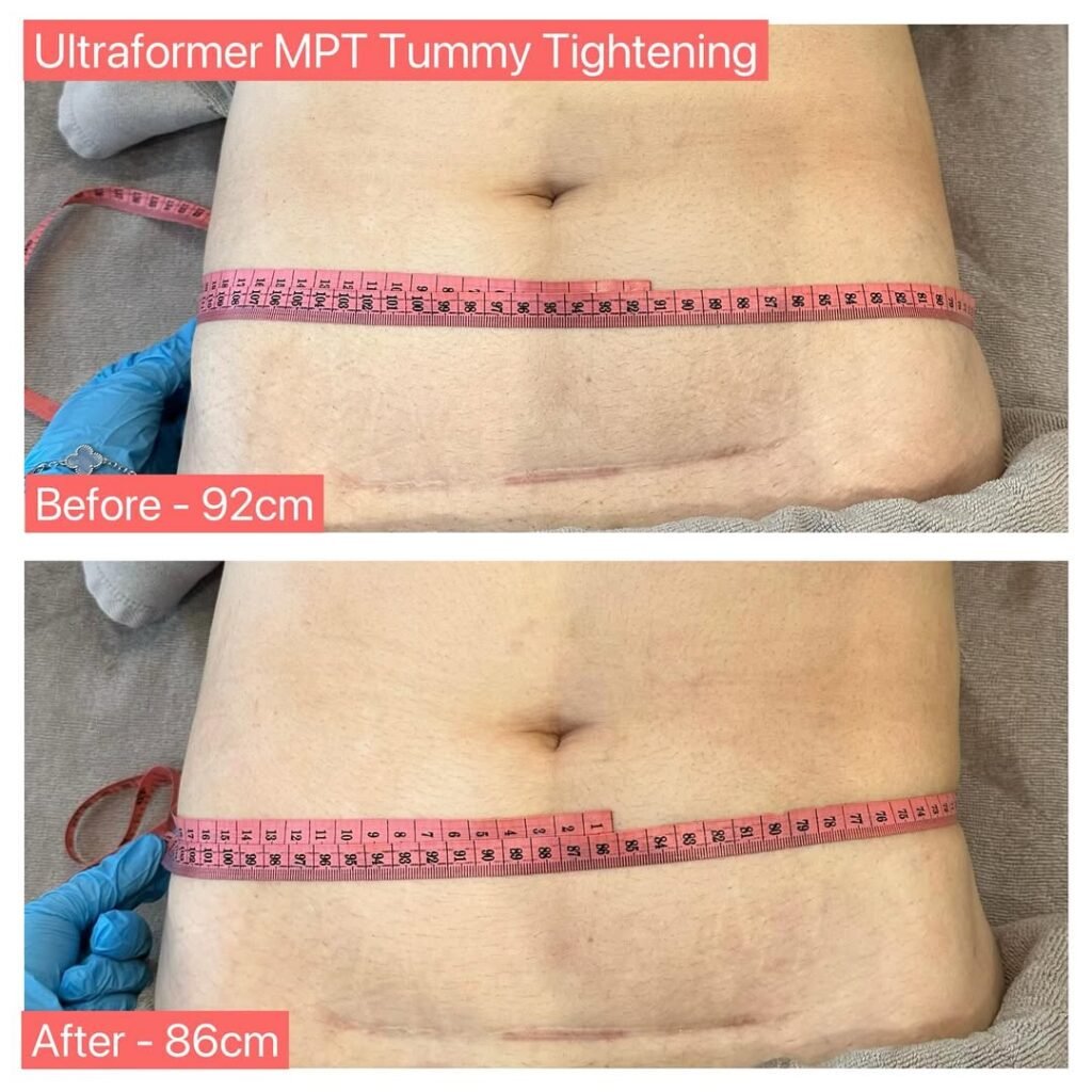 INSTANT CLIENT RESULTS Before after Ultraformer MPT TUMMY World No.1 Body Contouring Treatment MPT BODY SCULPTING - 13mm Depth Under Skin Fat Reduction Body Muscle Tightening V Line Contouring Cellulite R