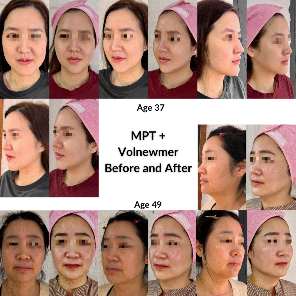 MPT + Volnewmer Before and After