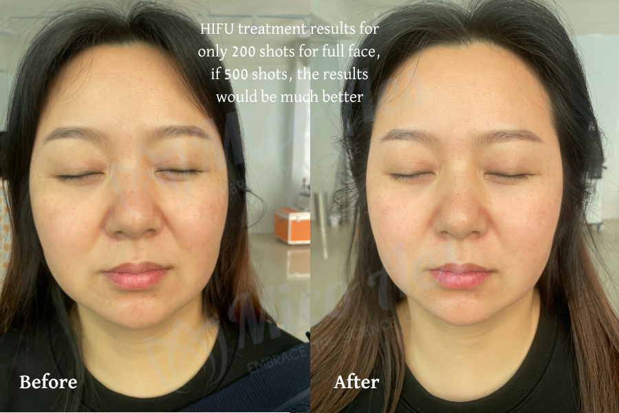 hifu treatment before and after face