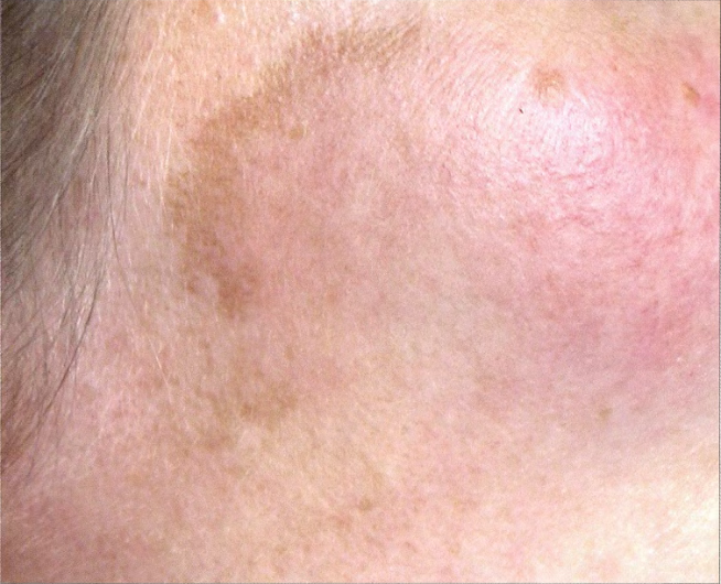 Hiperpigmentasi pasca-inflamasi (pipi)