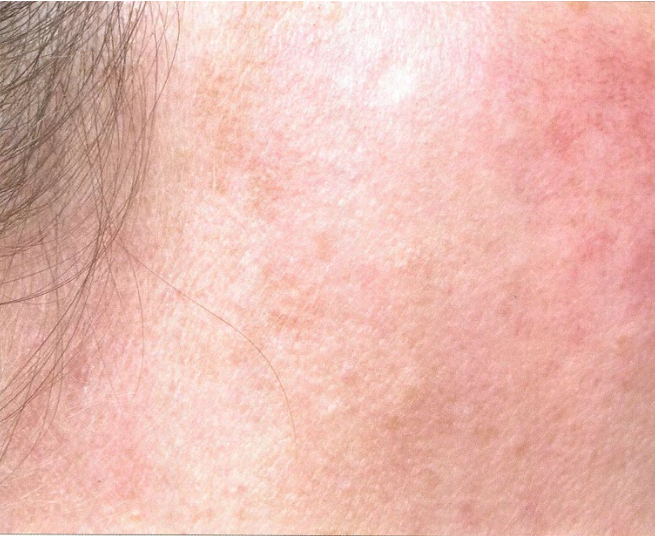 Pengobatan pasca-inflamasi hiperpigmentasi (pipi) setelah gambar