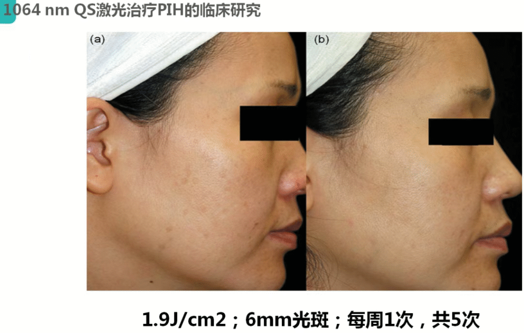 Q-Switched Laser Treatment PIH, 1.9J/cm2, ukuran spot 6mm, seminggu sekali, benar-benar 5 kali perawatan sebelum dan sesudah