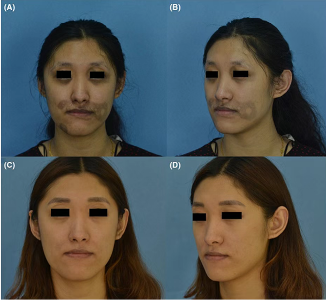 Energi sedang (4,0-4,5 J/cm²) Q-switched 1064 nm Pengaturan laser untuk mengobati PIH permanen sebelum dan sesudah