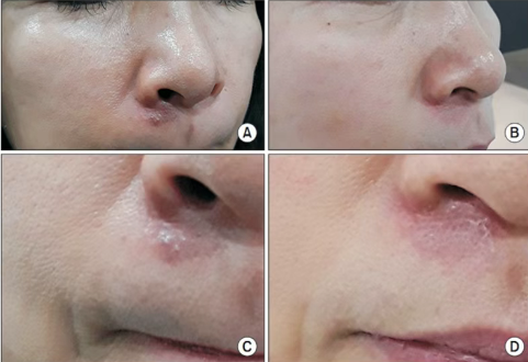 0.6j/cm2, ukuran spot 8mm, seminggu sekali, benar -benar 5 kali, pico plus