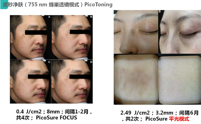Perawatan laser 755nm
