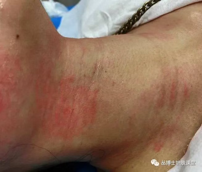 Ridges kulit pasca-prosedur dan linier ridges di leher (4,5 mm pada 0,9 J; 3,0 mm pada 0,35 J).