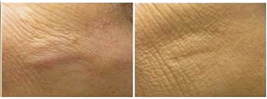 Depresi kulit linier setelah perawatan hifu