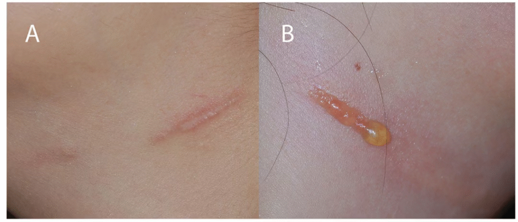 Lepuh linier yang disebabkan oleh hifu