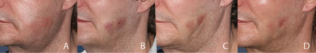 Terbakar setelah perawatan hifu