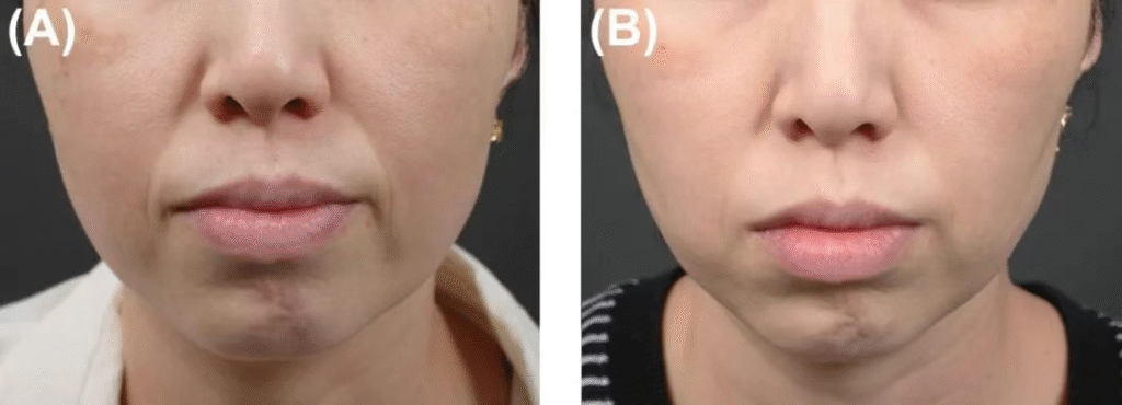 Depresi kulit area besar yang disebabkan oleh atrofi lemak setelah perawatan HIFU