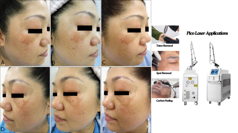 Wie effektiv ist der Q-Switched ND: YAG-Laser zur Behandlung von Melasma?