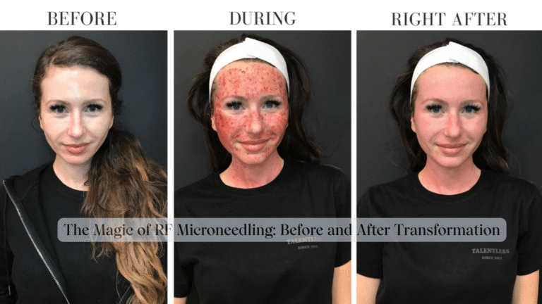 RF-Microneedling'in önünde ve sonra dönüşüm