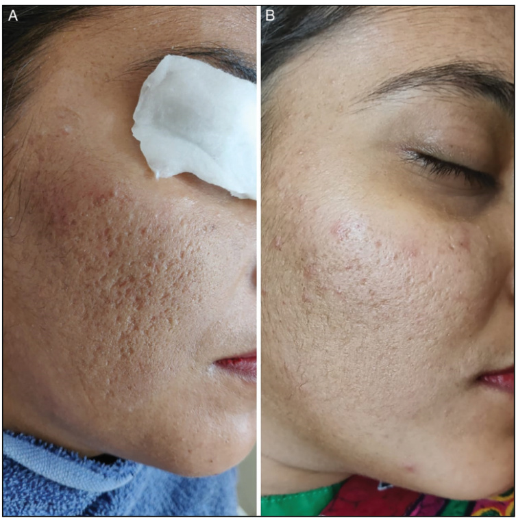 scar impovement for microneedling rf treatments, After 4 sessions of RF microneedling, acne scars were reduced by 85–90%, and the depth of depressions improved by over 50%.
