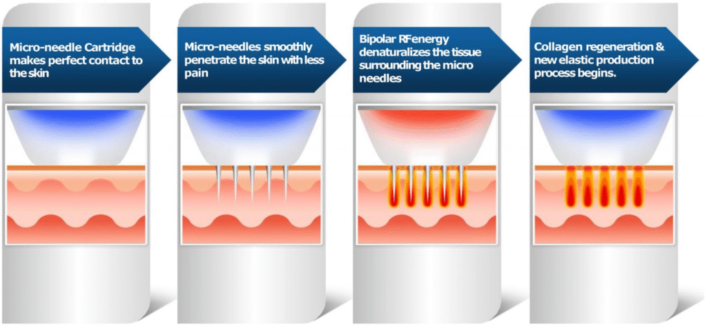 How does RF Microneedling work? and Core Mechanism
