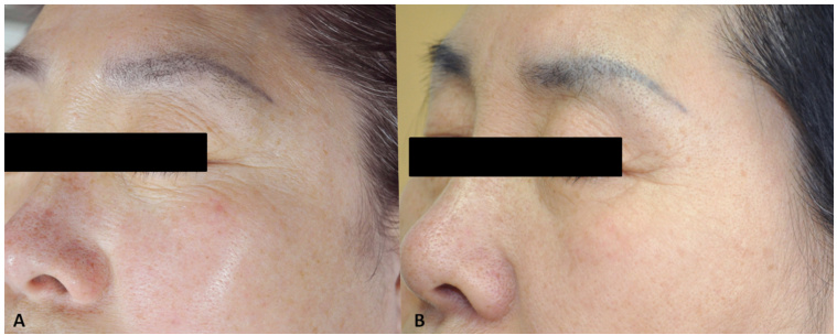Deep Wrinkles for microneedling rf treatments: A 74-year-old patient showed jawline laxity (Fig. 2A/B).