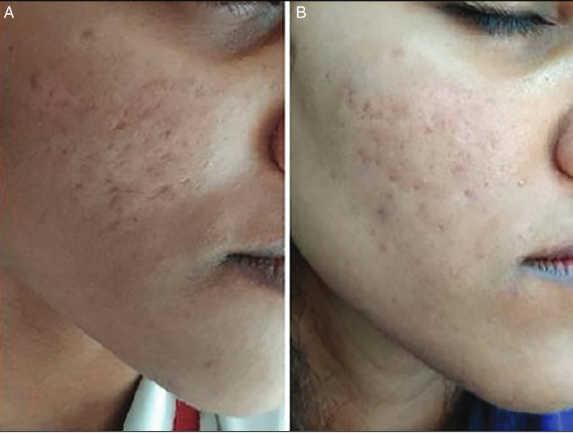 Acne Scars for rf microneedling treatments: Before treatment, dense atrophic scars are visible (Fig. A). After 3 sessions, scar smoothness improved by 60%, and pores appeared smaller.