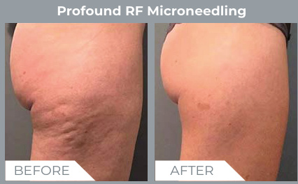 profound rf microneedling