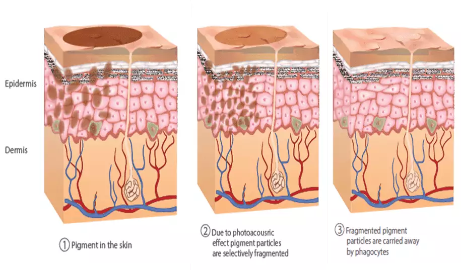 Q-Switched Laser: Mechanism