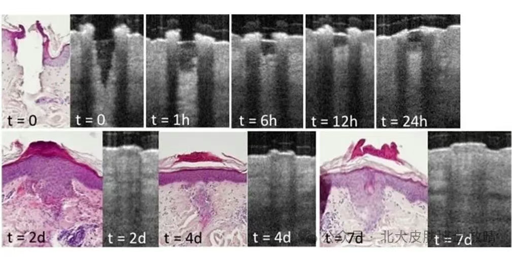 treatment results of co2 laser 