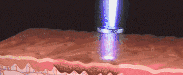 How CO₂ Fractional Laser Works