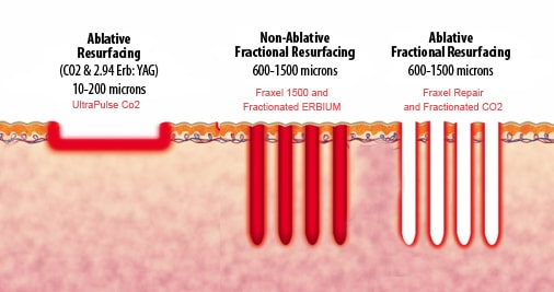 The Difference Between Ablative and Non-Ablative Fractional Lasers