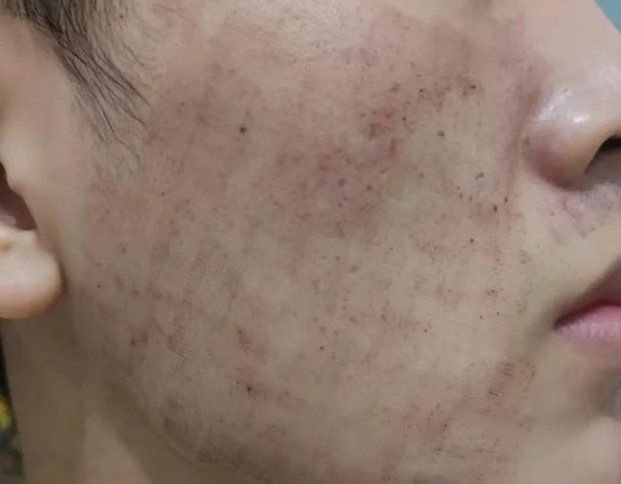 One Week After Ablative Fractional Laser Treatment