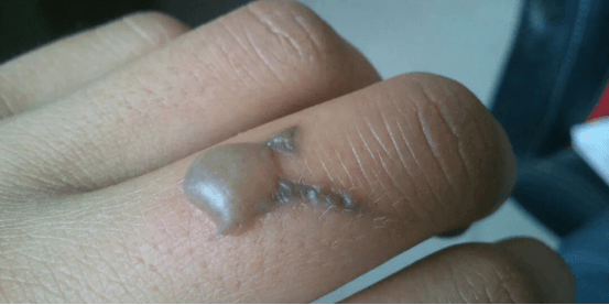 Blisters Occur After Tattoo Removal (2)