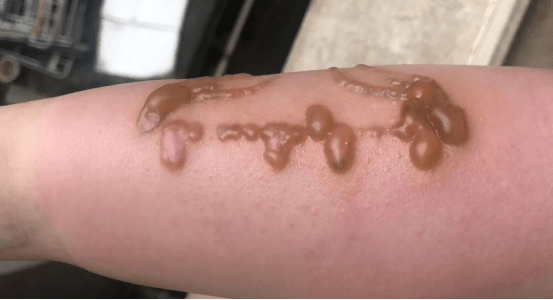 Blisters Occur After Tattoo Removal