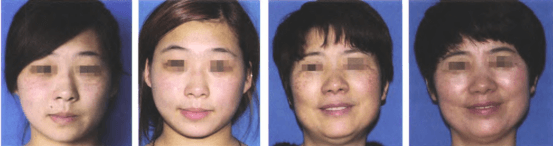 Figure-2.-Before-and-after-comparison-of-LFHSS-1064-nm-laser-treatment-for-Horis-nevus-dermal-melanocytosis