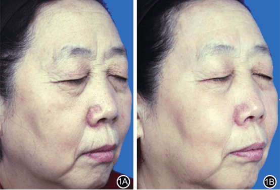 Figure-3.-Picosecond-fractional-laser-for-facial-rejuvenation-1A-before-treatment-1B-one-month-after-three-treatment-sessions