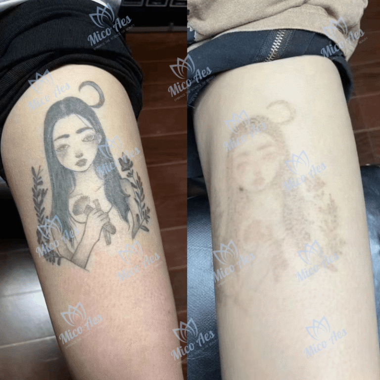 Reazioni degli endpoint del trattamento laser Una guida alla formazione clinica professionale