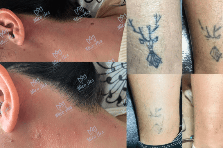 Picosecond vs Q-Switched Laser A Complete Guide to Endpoint Reactions & Điều chỉnh tham số