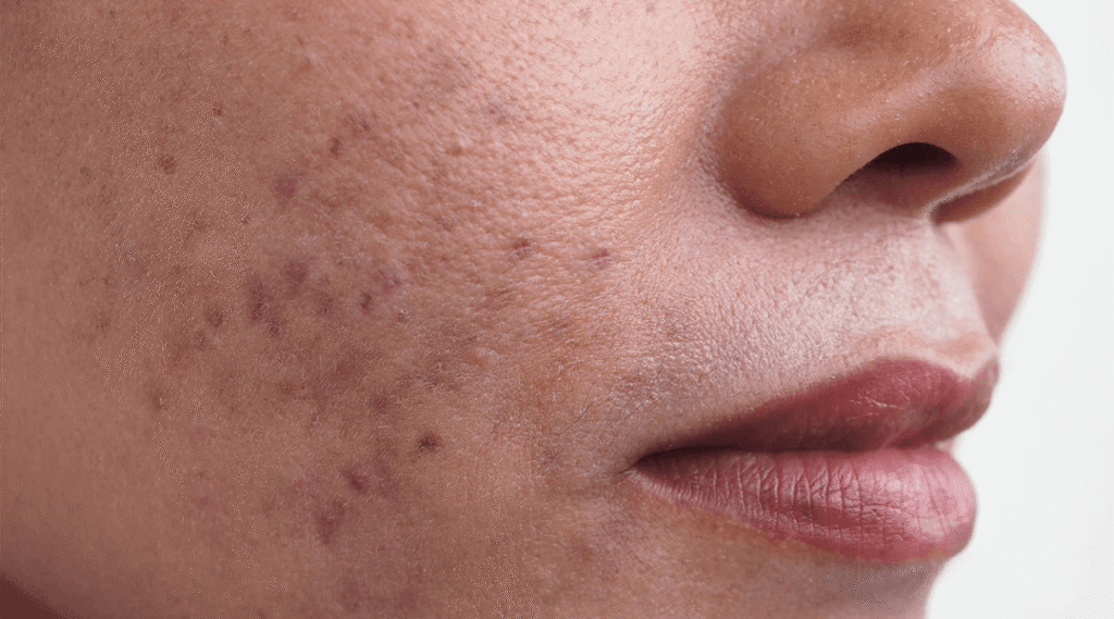 Post-Inflammatory Hyperpigmentation (PIH) (2)