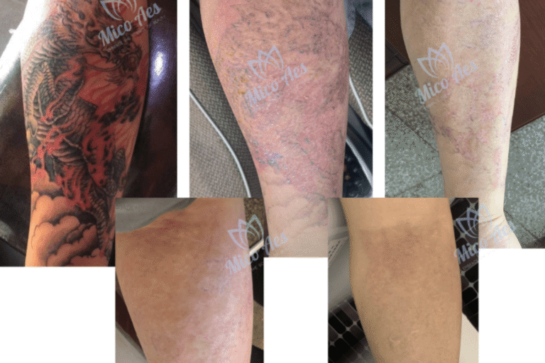 Guida alla formazione professionale per operatori di rimozione dei tatuaggi laser che padroneggiano tecniche e protocolli PicoWay®