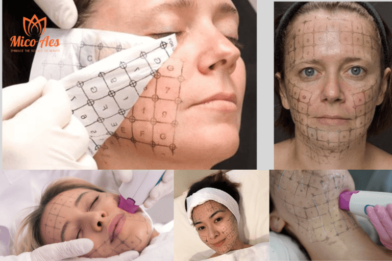 La tecnica Super Pass e il rafforzamento mirato che massimizzano i risultati del Thermage per una pelle più giovane e compatta (1)