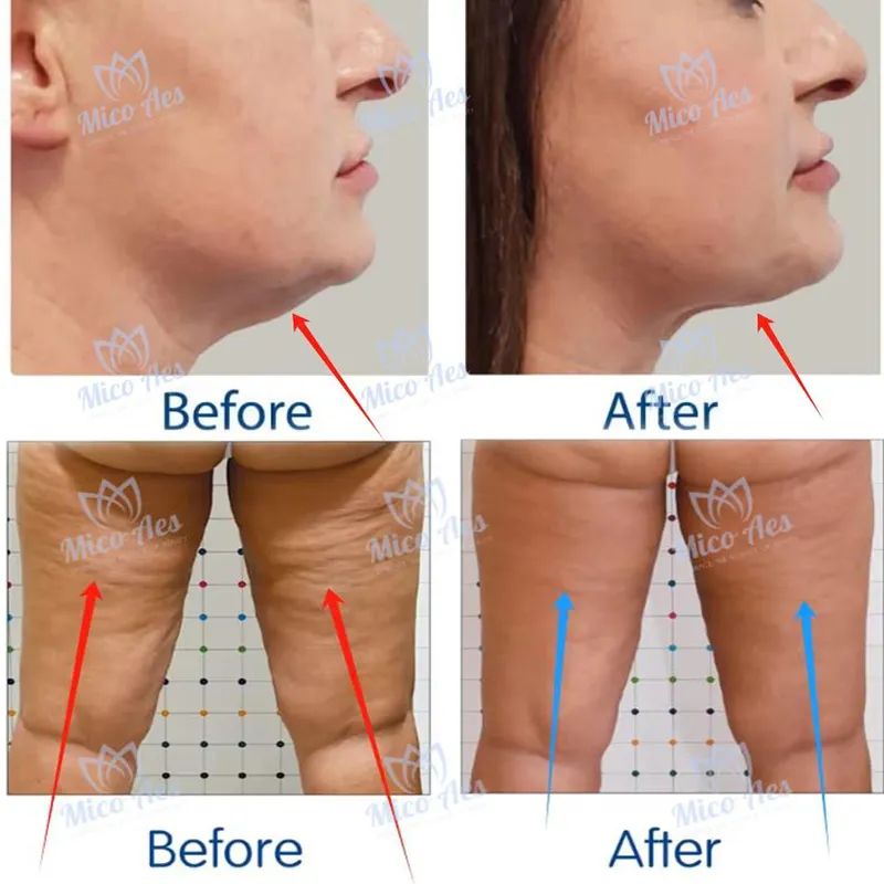 coolwave pro treatment before and after