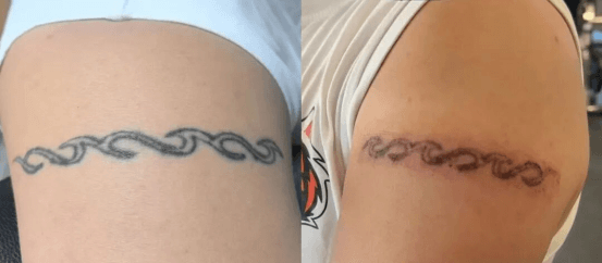 pico laser with fractional co2 laser work together for laser tattoo removal 