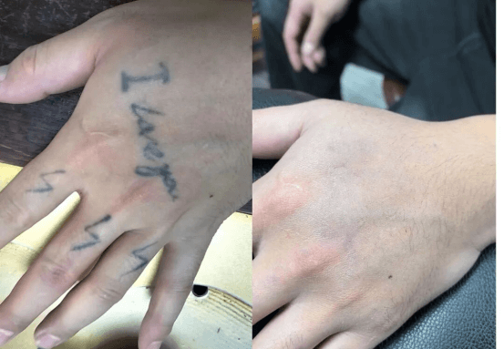 tattoo removal