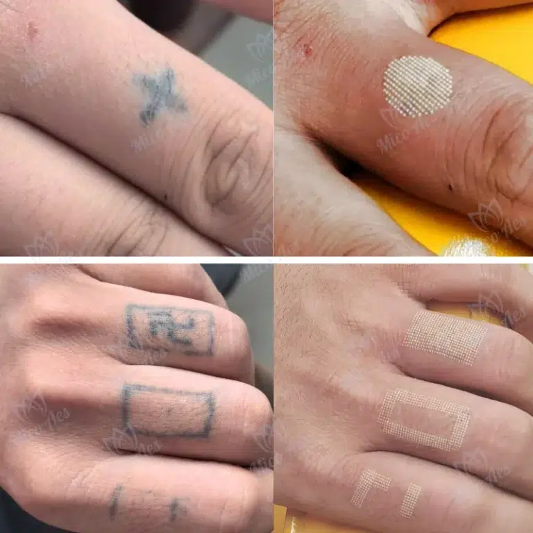 Pico laser and co2 fractional treatment before and after