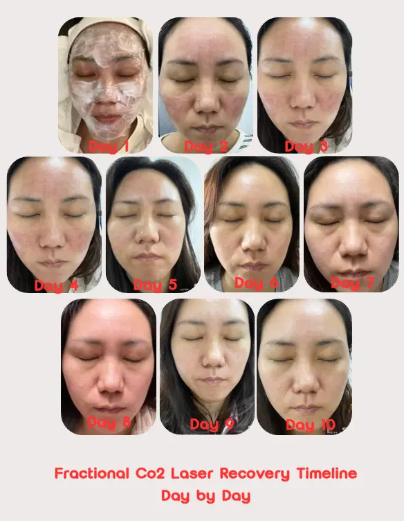 Fractional Co2 Laser Recovery Timeline Day by Day