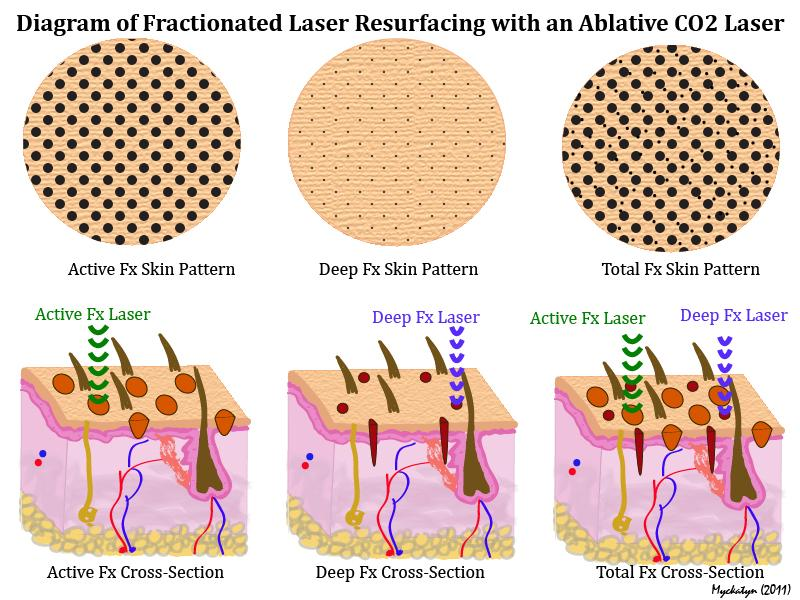 Diagram of fractional laser resurfacing with an ablative co2 laser