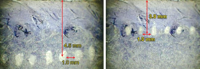 This heat creates thermal coagulation points (TCPs) approximately 1 mm in size.